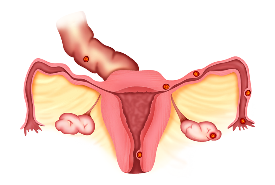 Medical 4c drawing- Uterine fibroids